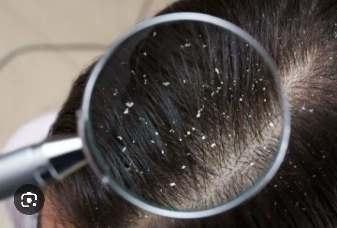 Antiforfora — trattamento capelli a Victoria's Hair Spa Ferrara